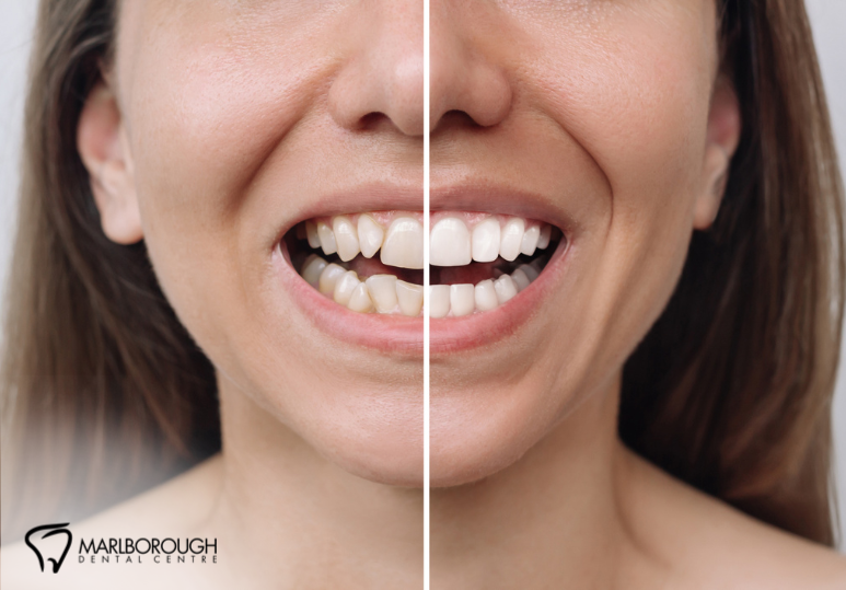 Caring for Your Veneers: Tips and Best Practices